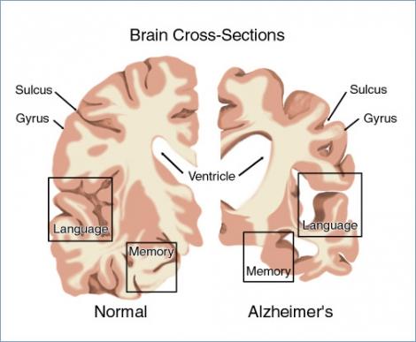 alzheimer.jpg