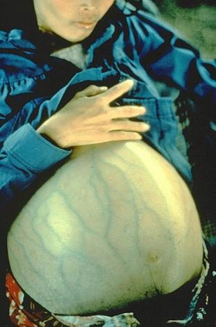 hepatitis-b.jpg