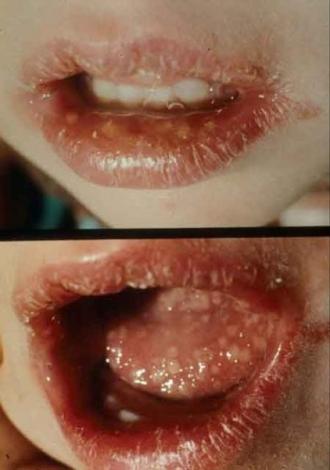 herpes-simplex-infekcija