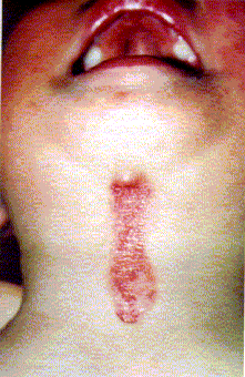 fisura-derma