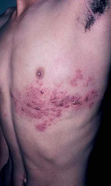 herpes-zoster