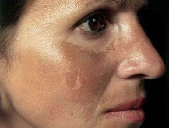 makula-dermatologija