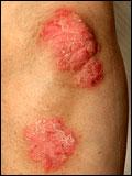 papula-dermatologija