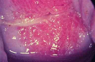 uretritis