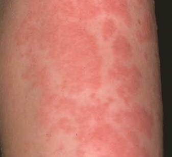 urtikarija-dermatologija